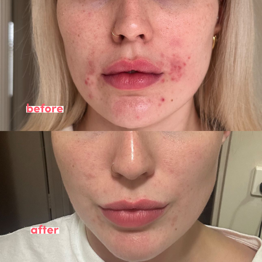 acne hack spot treatment (30mL) - tbhskincare